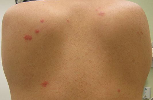 Bed Bug Pest Control Edmonton